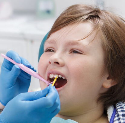 Combining Fluoride Treatments with Sealants for Maximum Cavity Protection