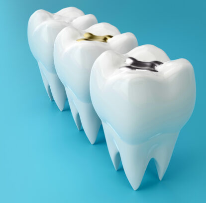 How Long Do Dental Fillings Last? Understanding the Lifespan of Fillings