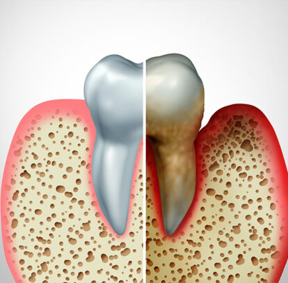Can Diet Affect the Risk of Root Canal Infection?