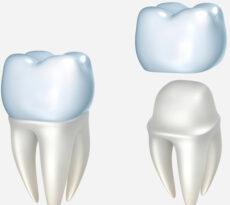 Dental Crowns
